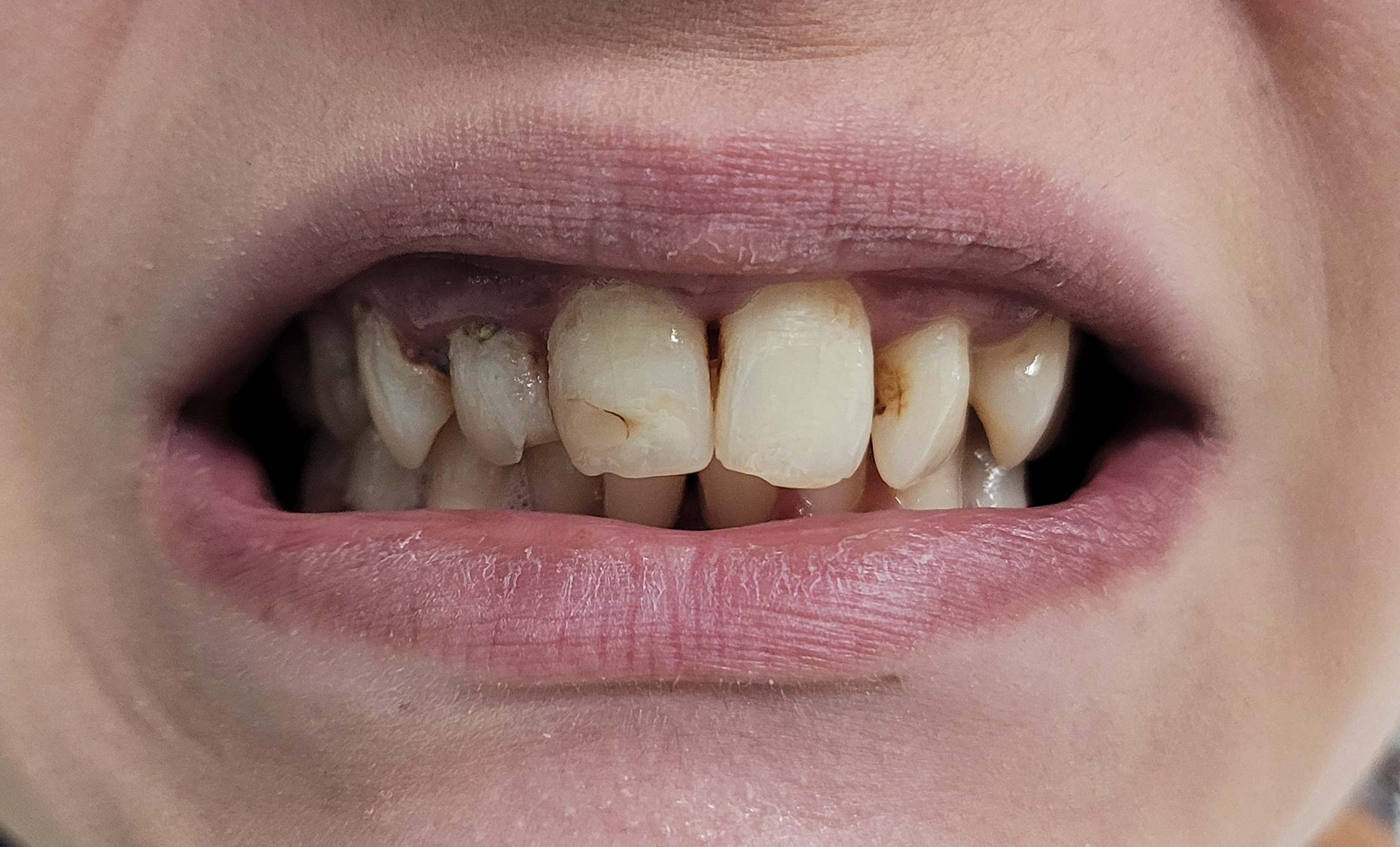 Coroane ceramica pe zirconiu si implanturi caz-initial