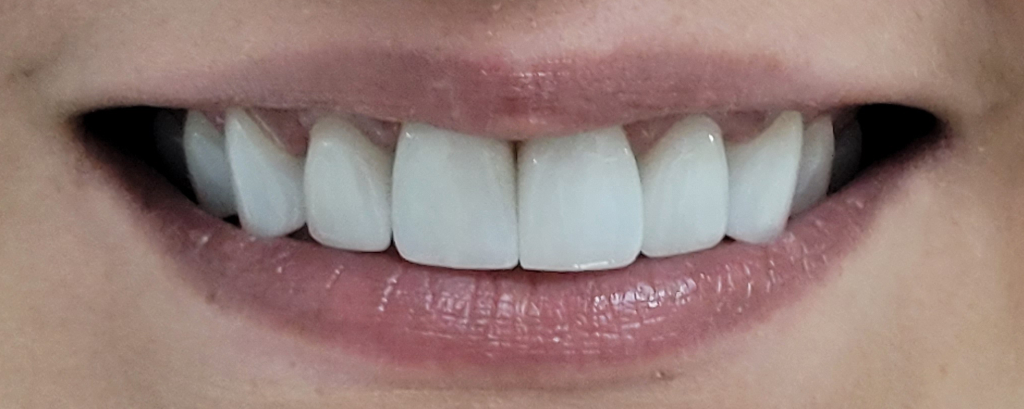 Coroane din ceramica pe zirconiu si implanturi dentare - situatia finala