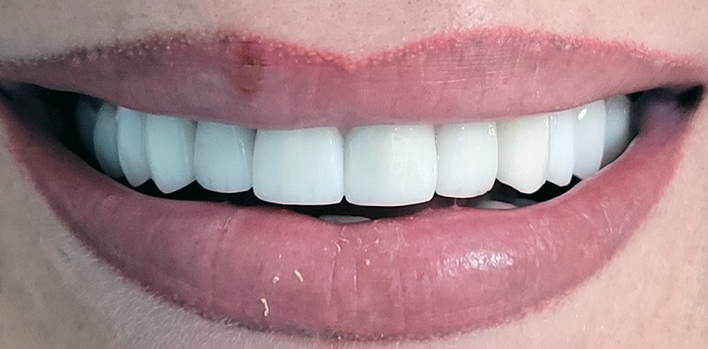 Coroane din ceramica pe suport din zirconiu - situatia finala