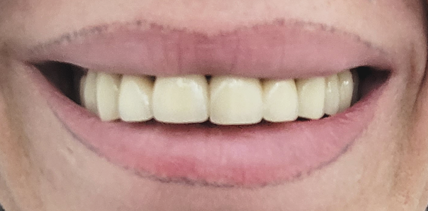 Coroane din ceramica pe suport din zirconiu - situatia initiala