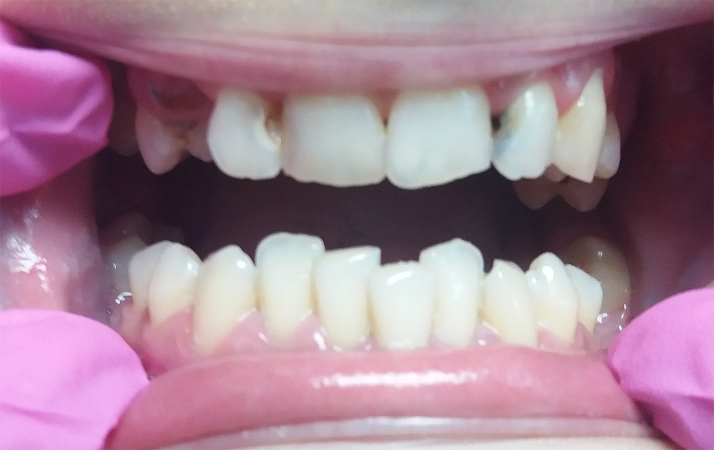 coroane de ceramica pe suport de zirconiu