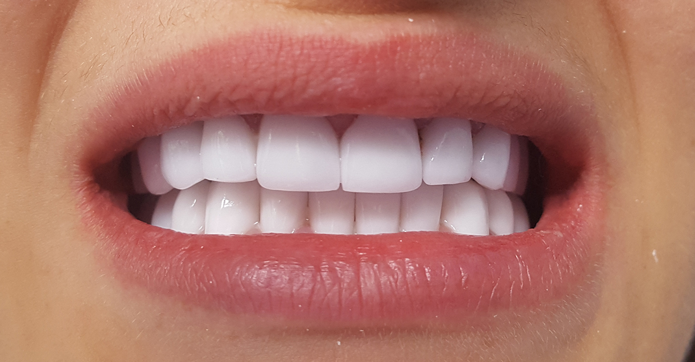 coroane de ceramica pe suport de zirconiu