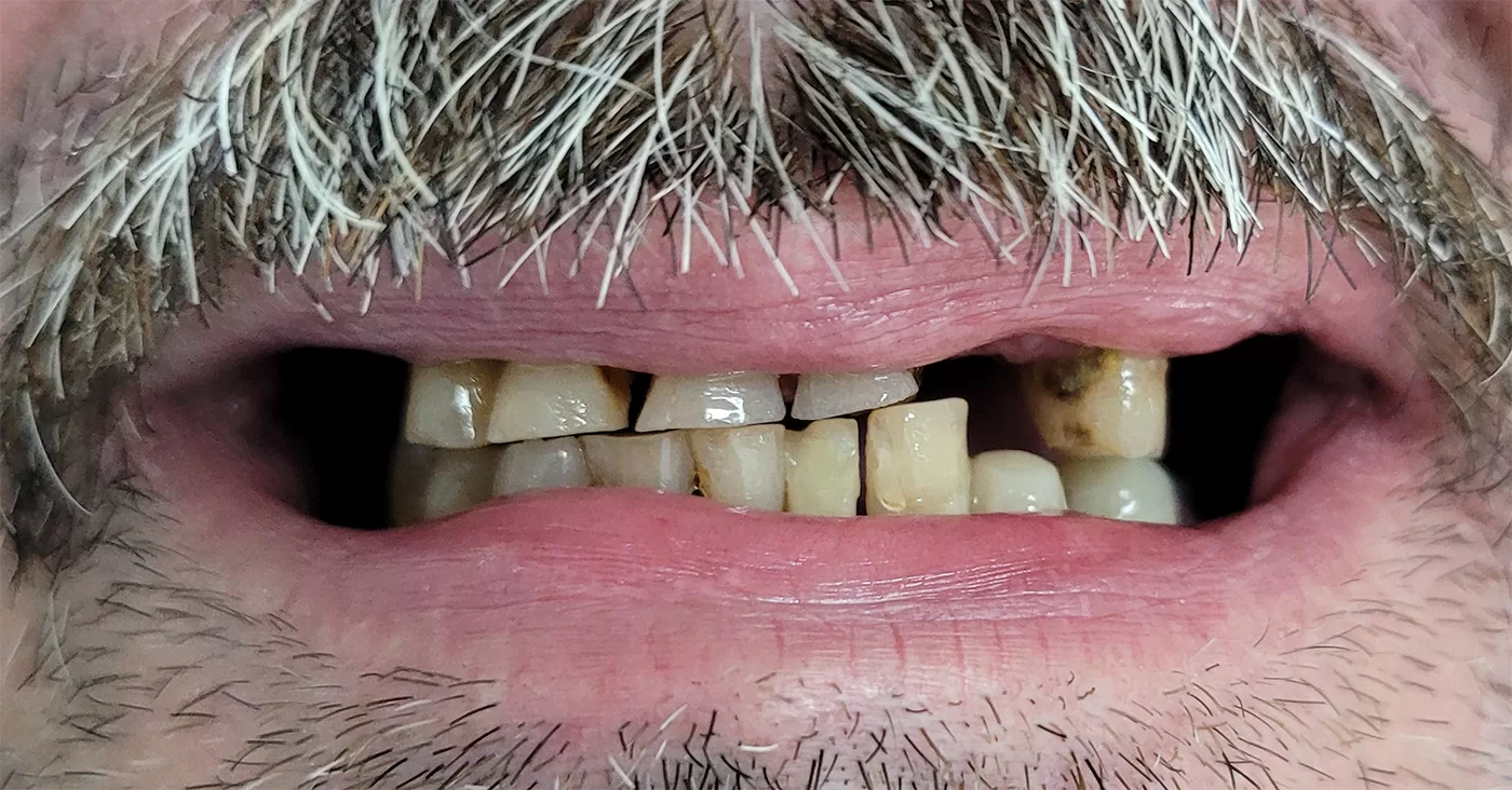 Coroane zirconiu multilayer - situatia initiala