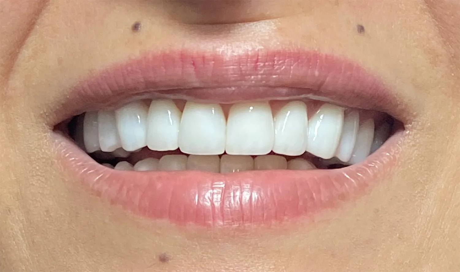 Coroane individuale ceramica pe zirconiu - situatia finala