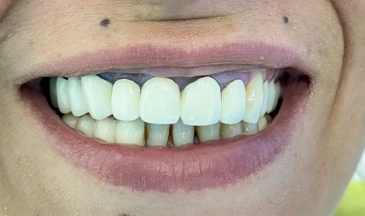 Coroane individuale ceramica pe zirconiu - situatia initiala