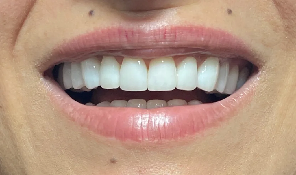 coroane individuale ceramica pe zirconiu