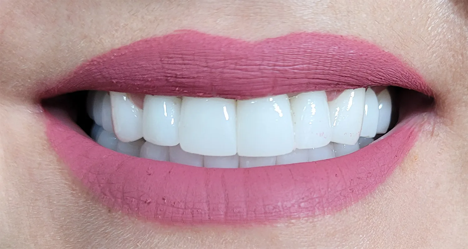 Coroane individuale zirconiu multilayer - situatia finala