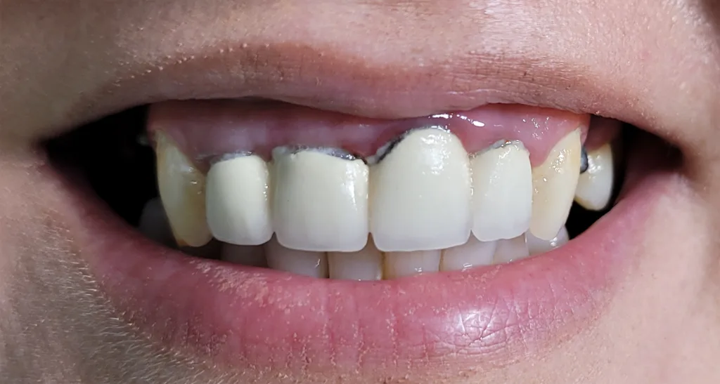 Coroane individuale zirconiu multilayer - initial