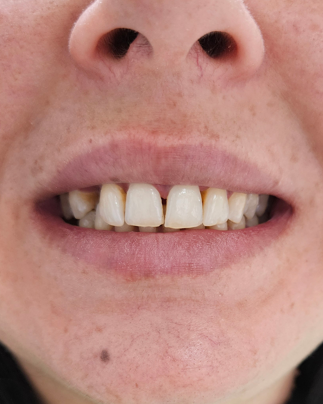 Coroane din zirconiu - situatia initiala