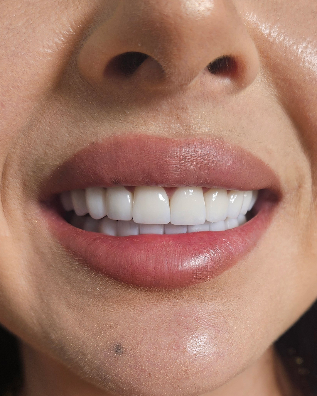 Coroane din zirconiu - situatia finala