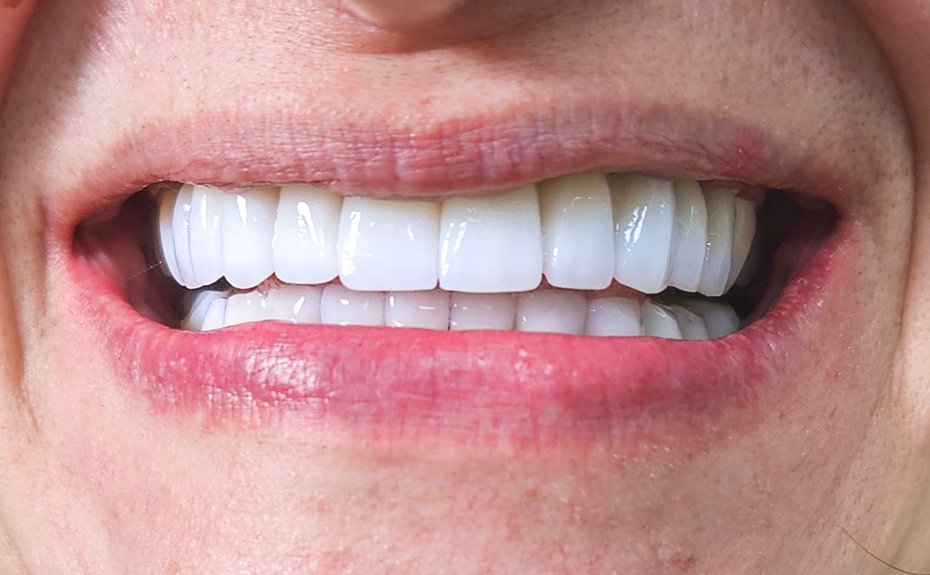 Coroane ceramica pe Zirconiu - situatia finala