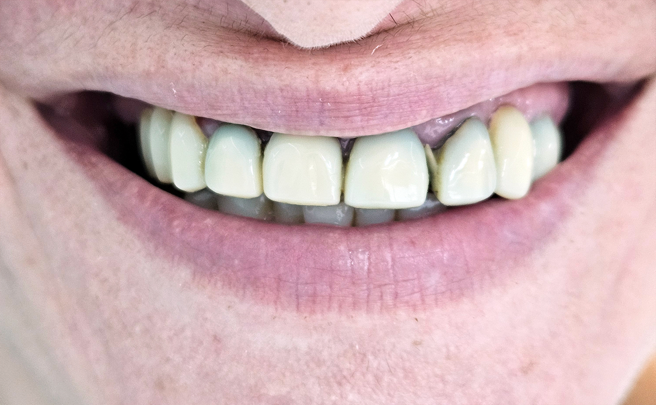 Coroane ceramica pe Zirconiu - situatia initiala