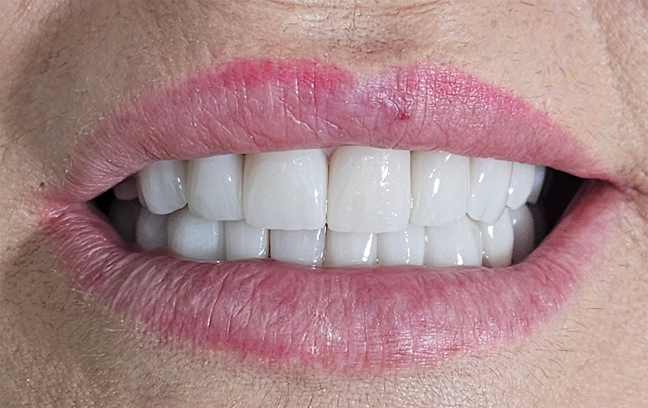 Coroane zirconiu – restaurare totala - situatia finala