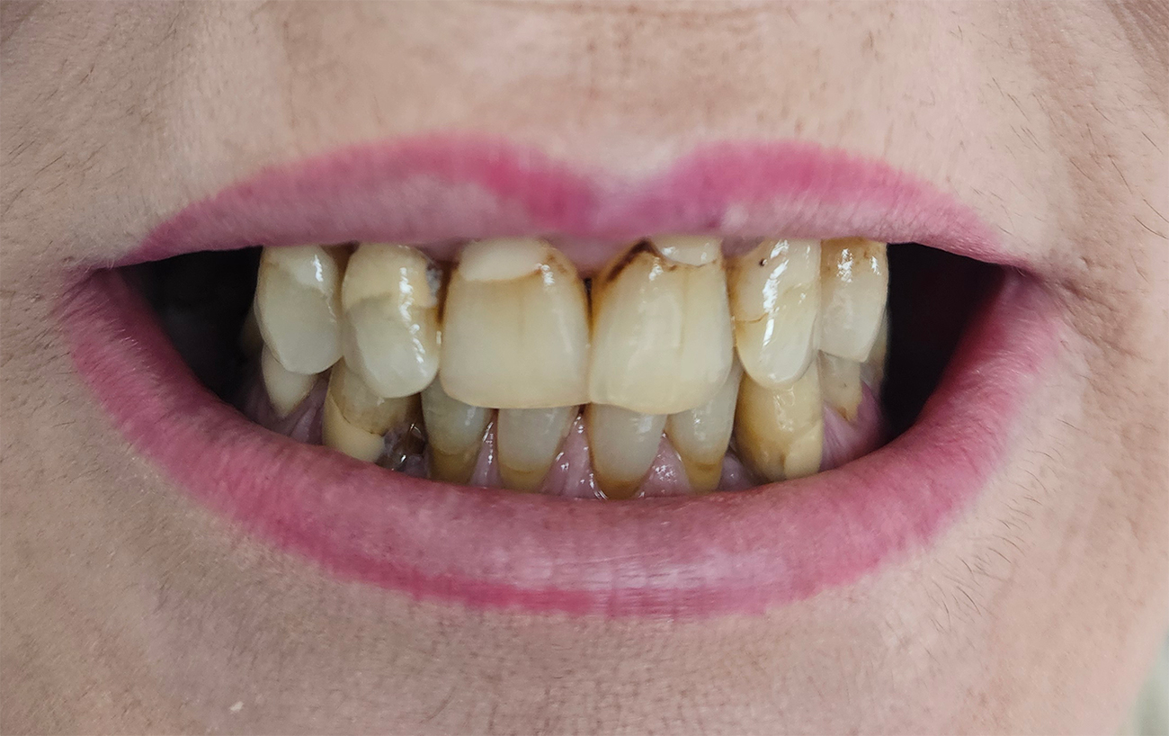 Coroane zirconiu – restaurare totala - situatia initiala